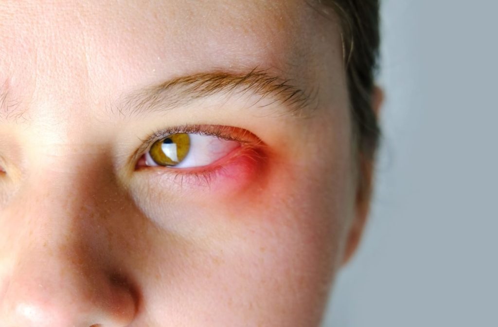 Young person with eye inflammation/infection.