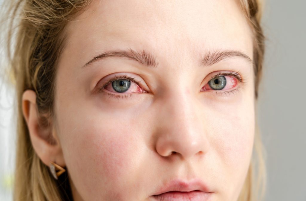 A close-up image of an adult with bloodshot eyes, showing the possible effects that marijuana can have on a person's eyes.